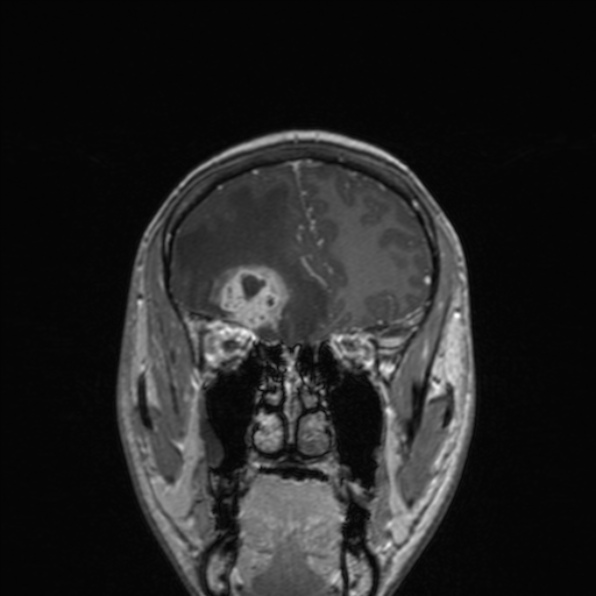 Cerebral abscess (Radiopaedia 24212-24478 Coronal T1 C+ 64).jpg