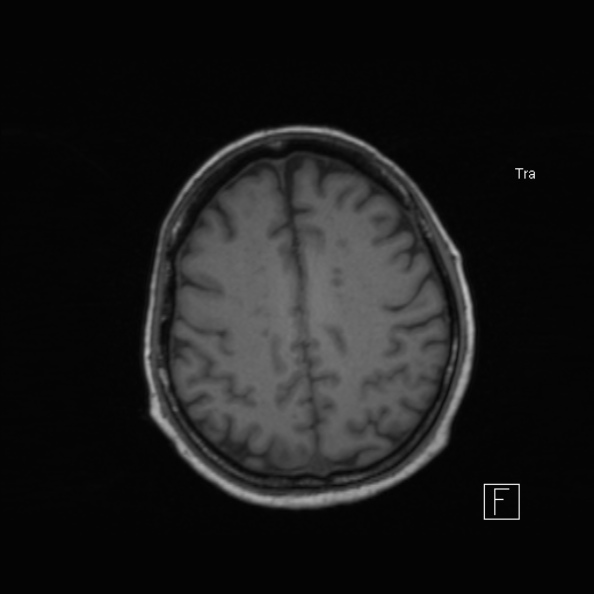 Cerebral abscess (Radiopaedia 26111-26247 Axial T1 42).jpg