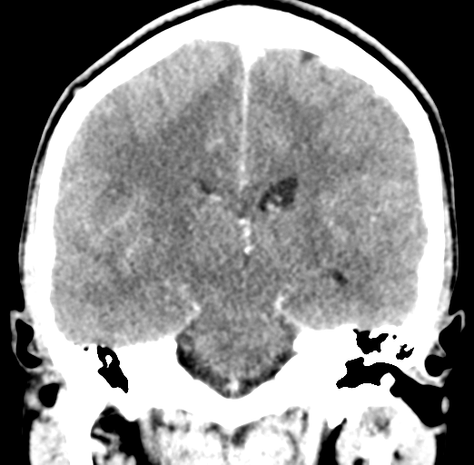 Cerebral abscess (Radiopaedia 60342-68008 Coronal C+ delayed 38).png