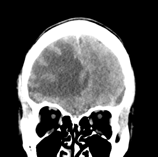 Cerebral abscess (Radiopaedia 60342-68008 Coronal non-contrast 15).png