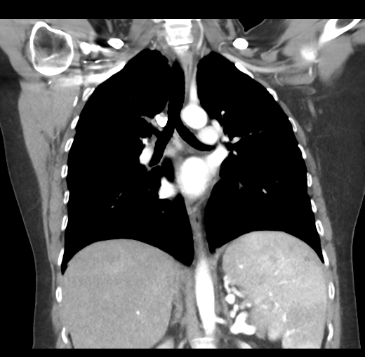Cerebral abscess from pulmonary arteriovenous malformation (Radiopaedia 86275-102292 C 30).png