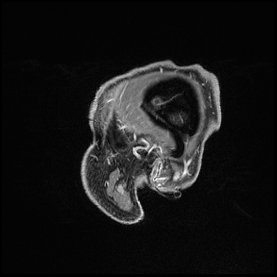 Cerebral abscess with ventriculitis (Radiopaedia 78965-91878 Sagittal T1 C+ 15).jpg