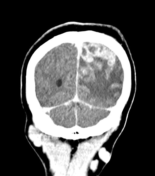 Cerebral abscesses (Radiopaedia 70458-80568 Coronal Contrast 57).jpg