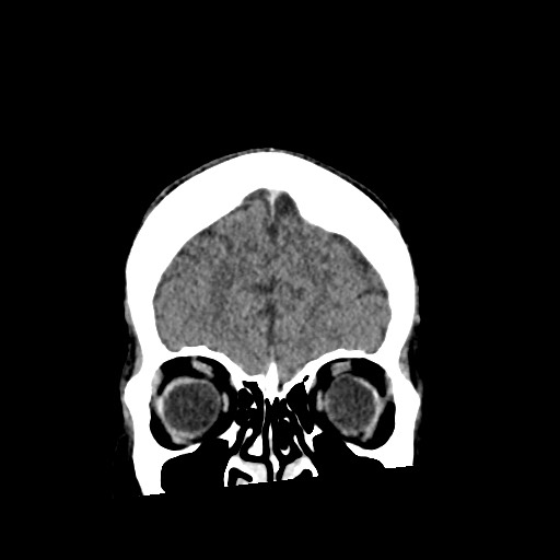 File:Cerebral amyloid angiopathy-related inflammation (Radiopaedia 74836-85848 Coronal non-contrast 14).jpg