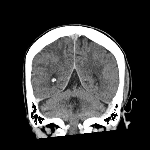 Cerebral amyloid angiopathy-related inflammation (Radiopaedia 74836-85848 Coronal non-contrast 50).jpg