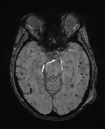 File:Cerebral amyloid angiopathy-related inflammation (Radiopaedia 74836-85849 Axial SWI 28).jpg