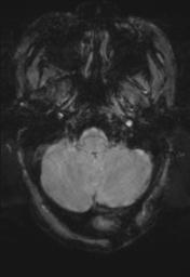 File:Cerebral amyloid angiopathy (Radiopaedia 29129-29518 Axial SWI Magnitude 5).jpg