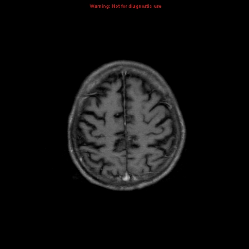 File:Cerebral and orbital tuberculomas (Radiopaedia 13308-13311 Axial T1 C+ 17).jpg