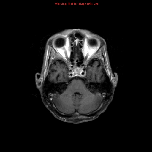 File:Cerebral and orbital tuberculomas (Radiopaedia 13308-13311 Axial T1 C+ 6).jpg