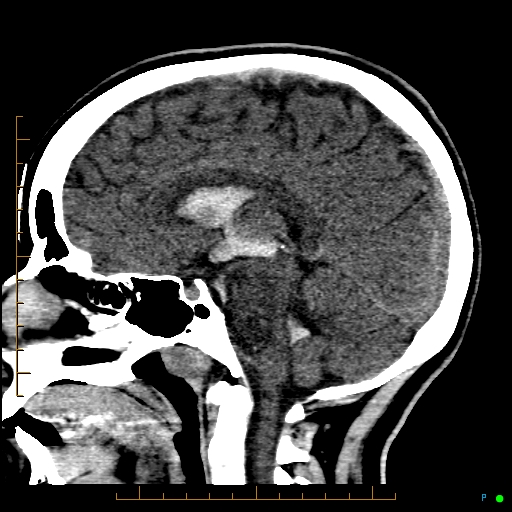 Cerebral arteriovenous malformation (AVM) (Radiopaedia 78162-90706 A 41).jpg