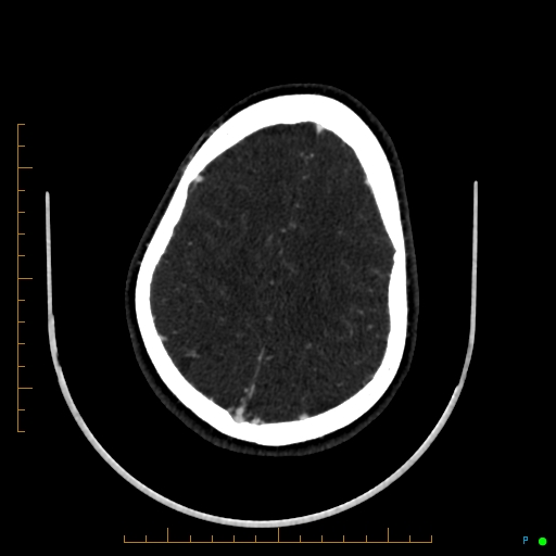 Cerebral arteriovenous malformation (AVM) (Radiopaedia 78162-90706 Axial CTA 214).jpg