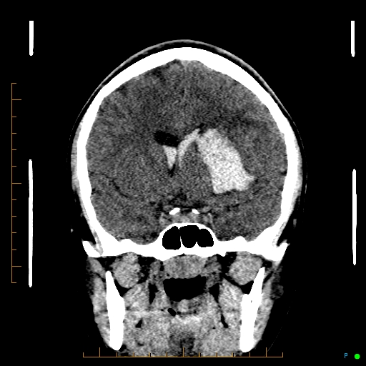 Cerebral arteriovenous malformation (AVM) (Radiopaedia 78162-90706 Coronal non-contrast 42).jpg
