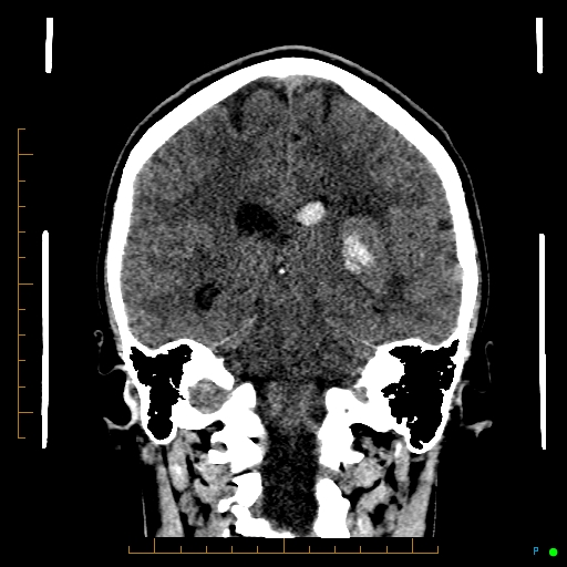 Cerebral arteriovenous malformation (AVM) (Radiopaedia 78162-90706 Coronal non-contrast 60).jpg