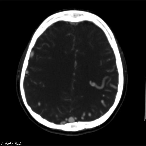 Cerebral arteriovenous malformation (Radiopaedia 28518-28759 B 39).jpg