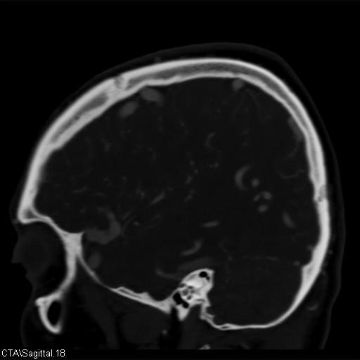 File:Cerebral arteriovenous malformation (Radiopaedia 28518-28759 D 15).jpg