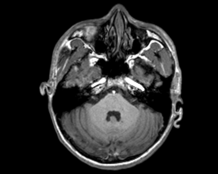 Cerebral arteriovenous malformation (Radiopaedia 30198-30813 Axial T1 44).jpg