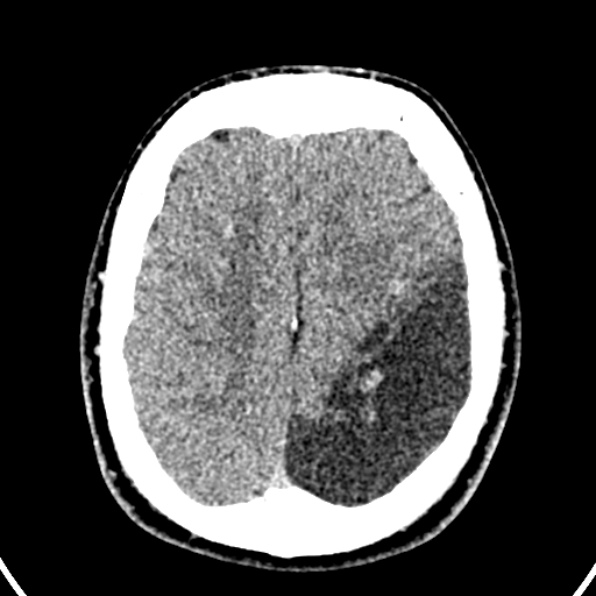 Cerebral arteriovenous malformation (Radiopaedia 37182-39012 Axial non-contrast 37).jpg