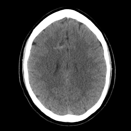 File:Cerebral arteriovenous malformation (Radiopaedia 39259-41505 Brain Ax 5mm 18).png