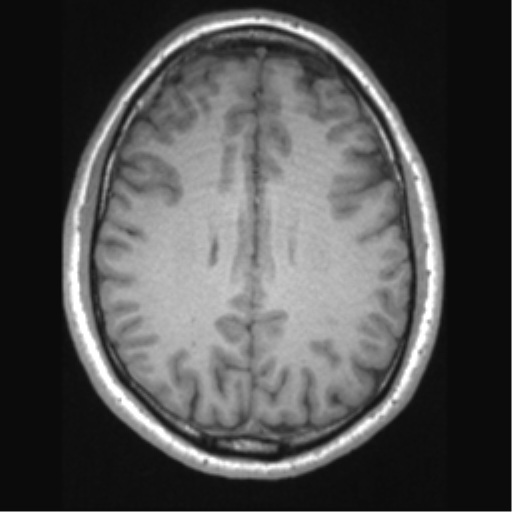 Cerebral arteriovenous malformation (Radiopaedia 39259-41506 Axial T1 51).png