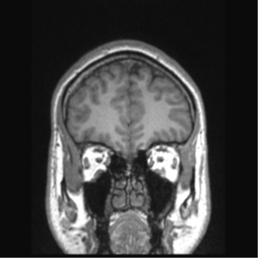 Cerebral arteriovenous malformation (Radiopaedia 39259-41506 Coronal T1 74).png