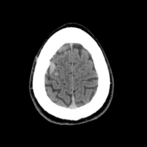 File:Cerebral arteriovenous malformation (Radiopaedia 55798-62371 Axial non-contrast 48).png