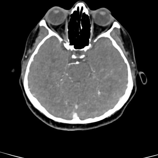 Cerebral arteriovenous malformation (Radiopaedia 73830-84645 B 66).jpg