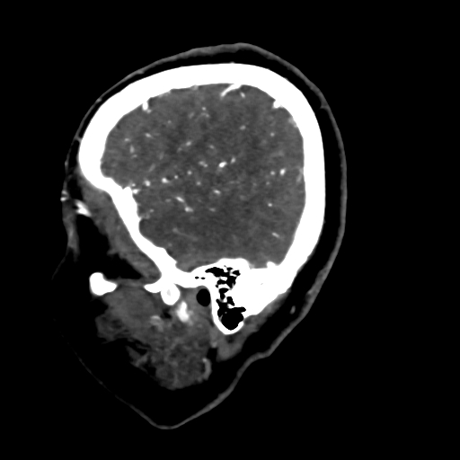 Cerebral arteriovenous malformation (Radiopaedia 73830-84645 Sagittal C+ delayed 13).jpg