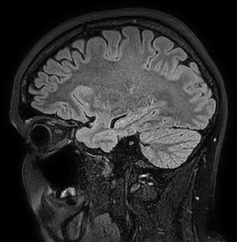 Cerebral arteriovenous malformation (Radiopaedia 74411-85654 Sagittal FLAIR 36).jpg