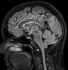 Cerebral arteriovenous malformation (Radiopaedia 74411-85654 Sagittal FLAIR 59).jpg