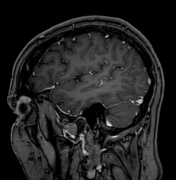 Cerebral arteriovenous malformation (Radiopaedia 74411-85746 Sagittal T1 C+ 21).jpg
