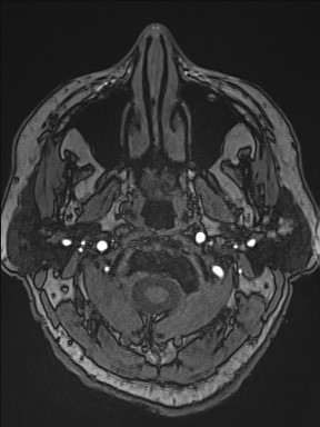 Cerebral arteriovenous malformation (Radiopaedia 84015-99245 Axial TOF 18).jpg