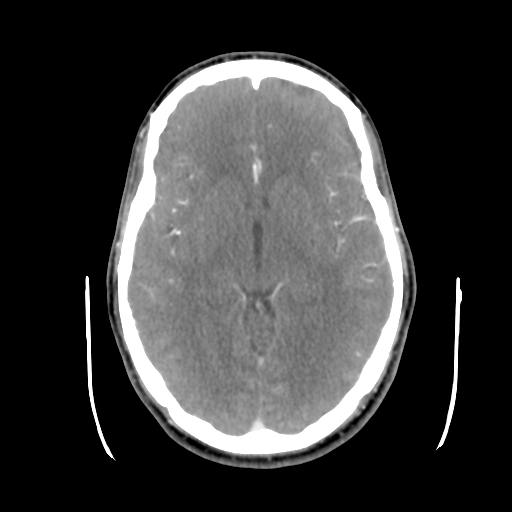 Cerebral arteriovenous malformation (Spetzler-Martin grade 2) (Radiopaedia 41262-44076 Axial C+ 24).png