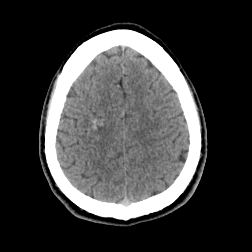Cerebral arteriovenous malformation (Spetzler-Martin grade 2) (Radiopaedia 41262-44076 Axial non-contrast 43).png