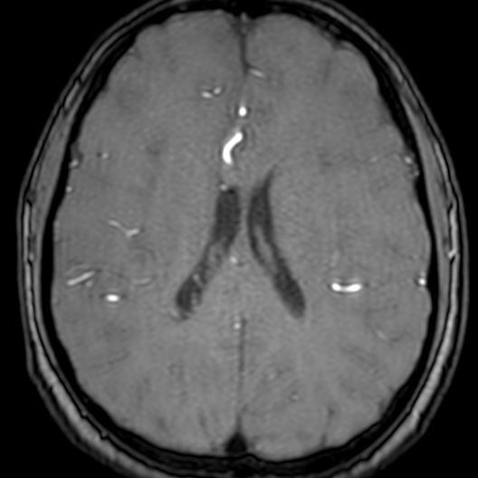 Cerebral arteriovenous malformation at posterior body of corpus callosum (Radiopaedia 74111-84925 Axial MRA 135).jpg