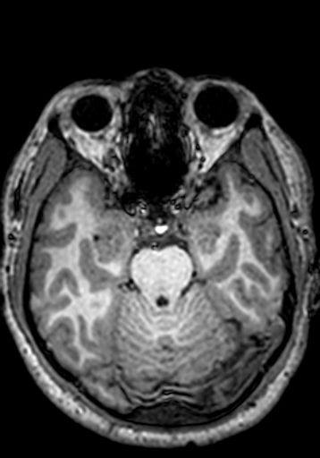 Cerebral arteriovenous malformation at posterior body of corpus callosum (Radiopaedia 74111-84925 Axial T1 206).jpg