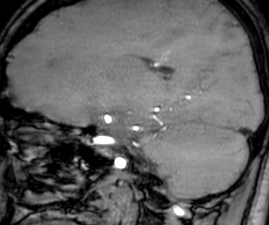 Cerebral arteriovenous malformation at posterior body of corpus callosum (Radiopaedia 74111-84925 J 147).jpg