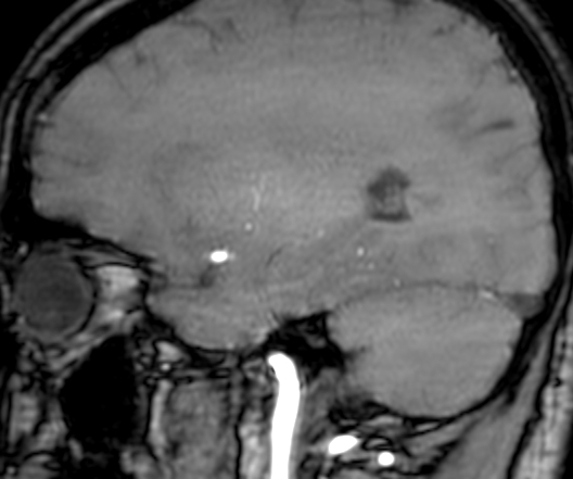 Cerebral arteriovenous malformation at posterior body of corpus callosum (Radiopaedia 74111-84925 J 280).jpg