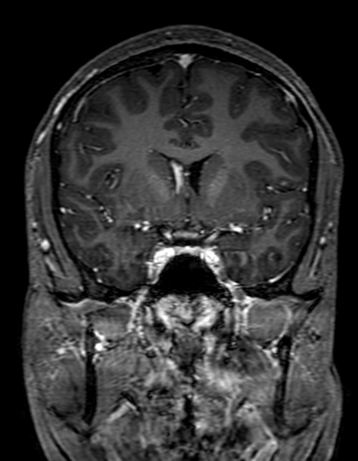 Cerebral arteriovenous malformation at posterior body of corpus callosum (Radiopaedia 74111-84925 K 144).jpg