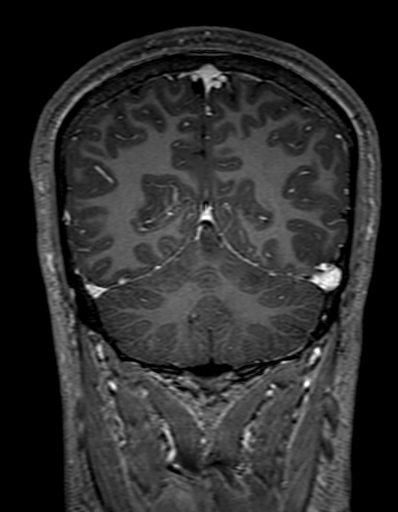 Cerebral arteriovenous malformation at posterior body of corpus callosum (Radiopaedia 74111-84925 K 282).jpg