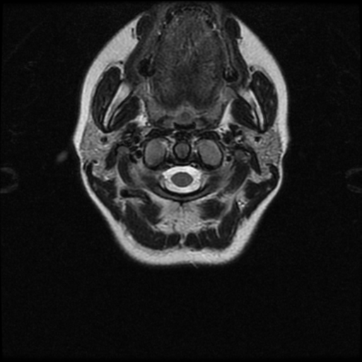 Cerebral autosomal dominant arteriopathy with subcortical infarcts and leukoencephalopathy (CADASIL) (Radiopaedia 41018-43763 Ax T2 C2-T1 27).png