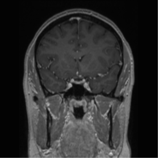 Cerebral cavernoma and development venous anomaly (Radiopaedia 37603-39482 Coronal T1 C+ 61).png