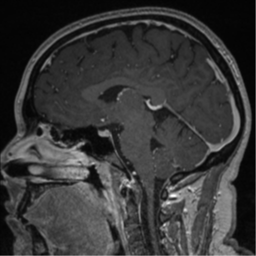 Cerebral cavernoma and development venous anomaly (Radiopaedia 37603-39482 Sagittal T1 C+ 51).png