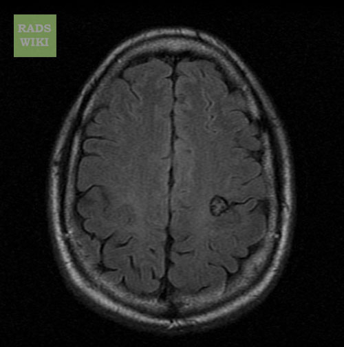 File:Cerebral cavernous malformation (Radiopaedia 11284-11648 Axial 2).jpg
