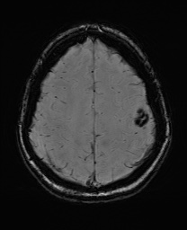 Cerebral cavernous venous malformation (Radiopaedia 70008-80021 I 58).jpg