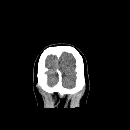 Cerebral cavernous venous malformation (Radiopaedia 70008-80022 non-contrast 67).jpg
