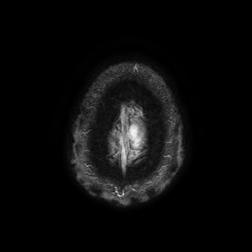 Cerebral cavernous venous malformation (Zabramski type II) (Radiopaedia 85511-101198 Axial SWI 111).jpg