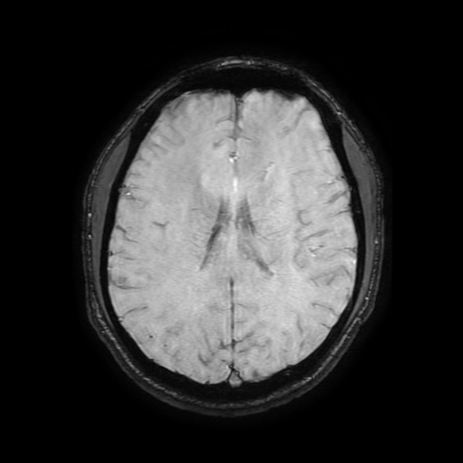 Cerebral cavernous venous malformation (Zabramski type II) (Radiopaedia 85511-101198 Axial SWI 76).jpg