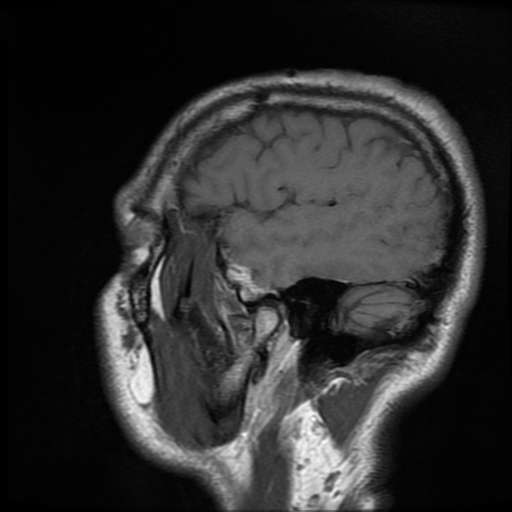 File:Cerebral cavernous venous malformation (Zabramski type II) (Radiopaedia 85511-101198 Sagittal T1 8).jpg