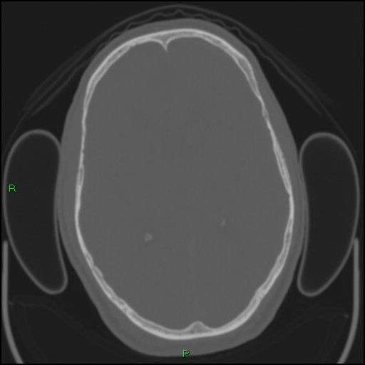 Cerebral contusions (Radiopaedia 33868-35039 Axial bone window 110).jpg