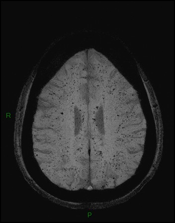 Cerebral fat embolism (Radiopaedia 35022-36525 Axial SWI 38).jpg